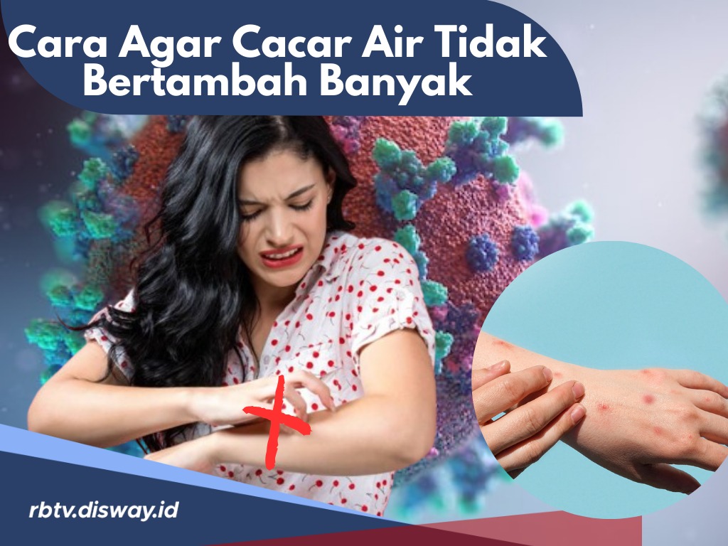 Merasa Tersiksa, Lakukan 7 Cara Ini Mencegah Cacar Air agar Tidak Bertambah Banyak