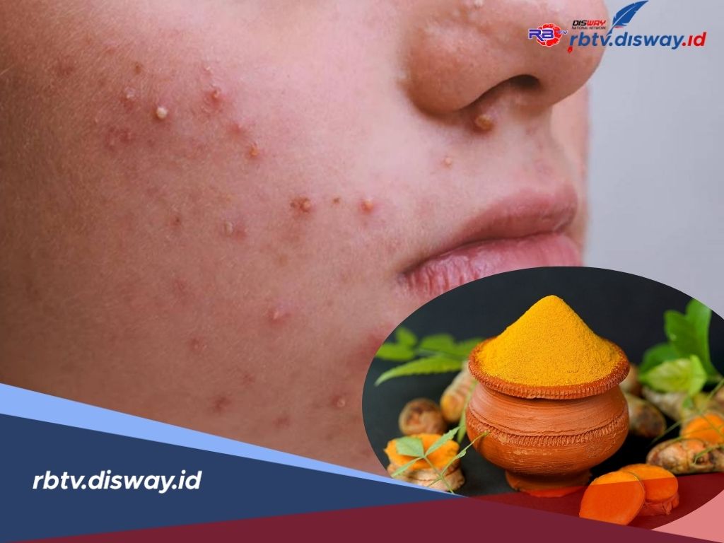 Lebih Ampuh, Ini Resep Obat Jerawat dr Zaidul Akbar, Coba dan Rasakan Khasiatnya