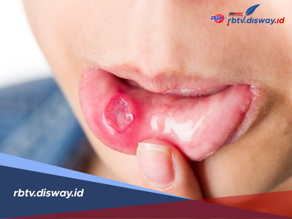 Bukan Sekadar Luka, Ini Penyebab Sariawan Menurut Ustadz Dhanu