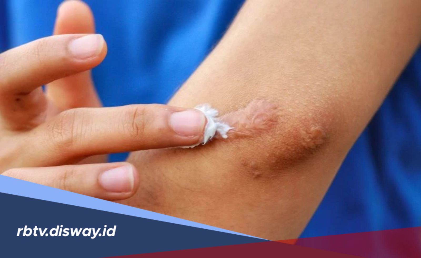 Cara Mengatasi dan Menghilangkan Bekas Luka Agar Kulit Kembali Mulus