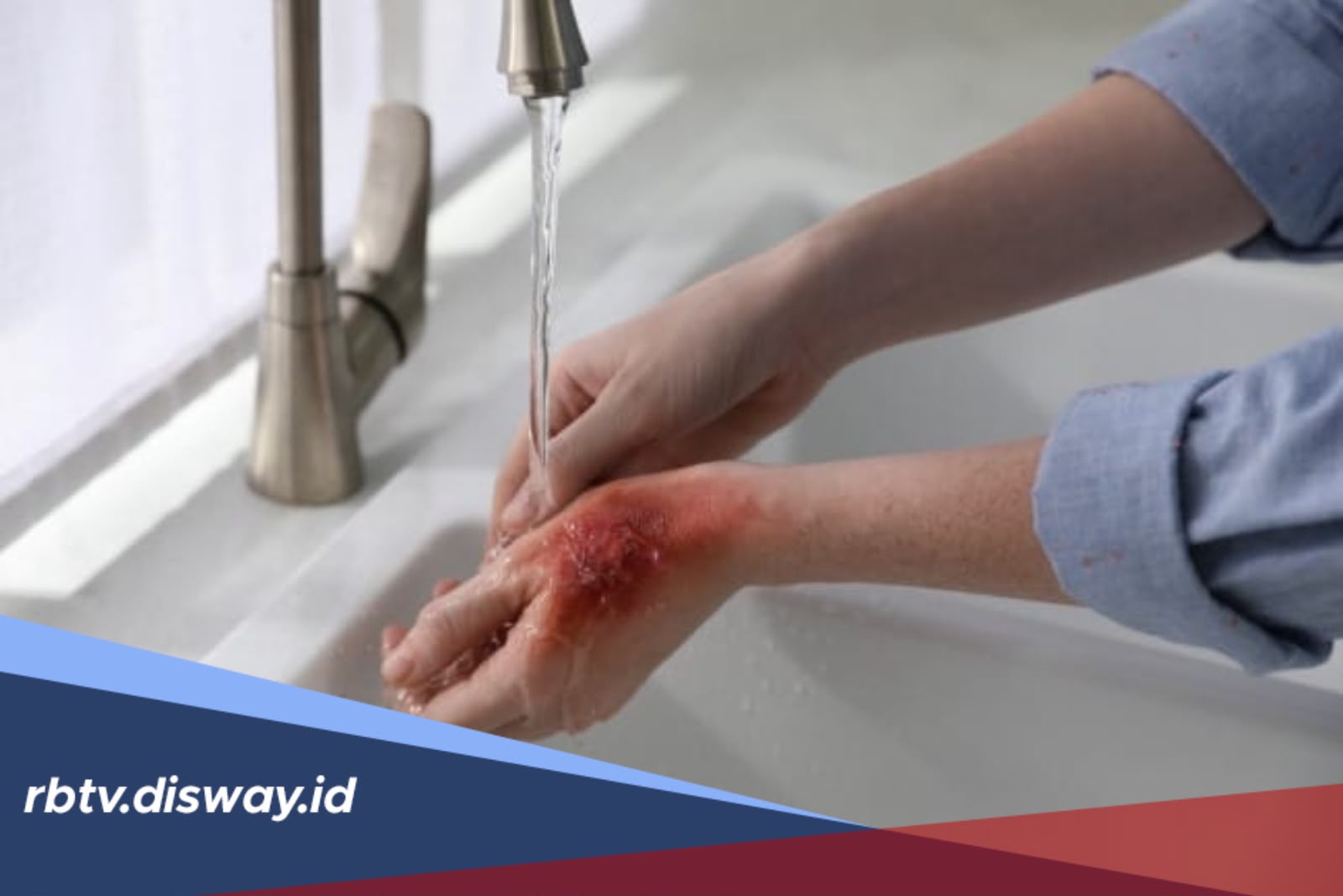 Kulit Terkena Air Panas? Ini Langkah Pertolongan Pertama yang Tepat