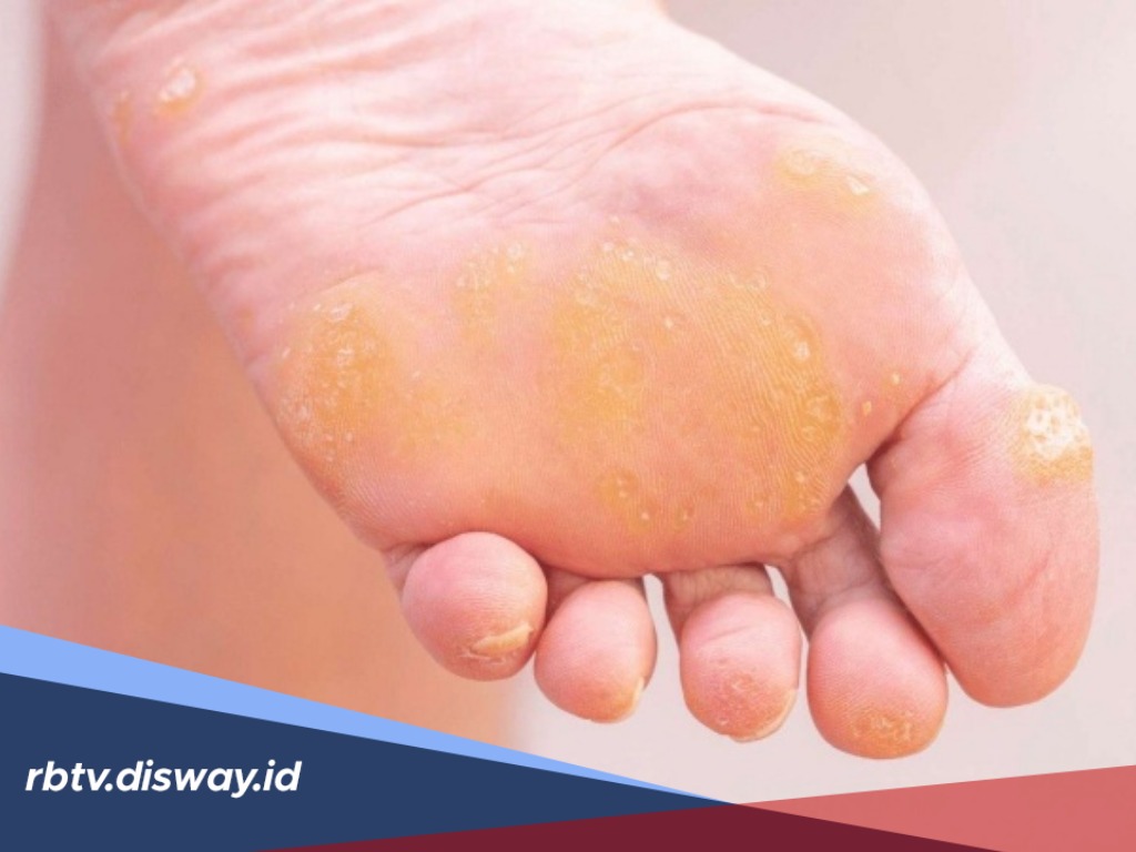 5 Cara Ampuh Hilangkan Kapalan di Kaki dan Tangan Tanpa Perih