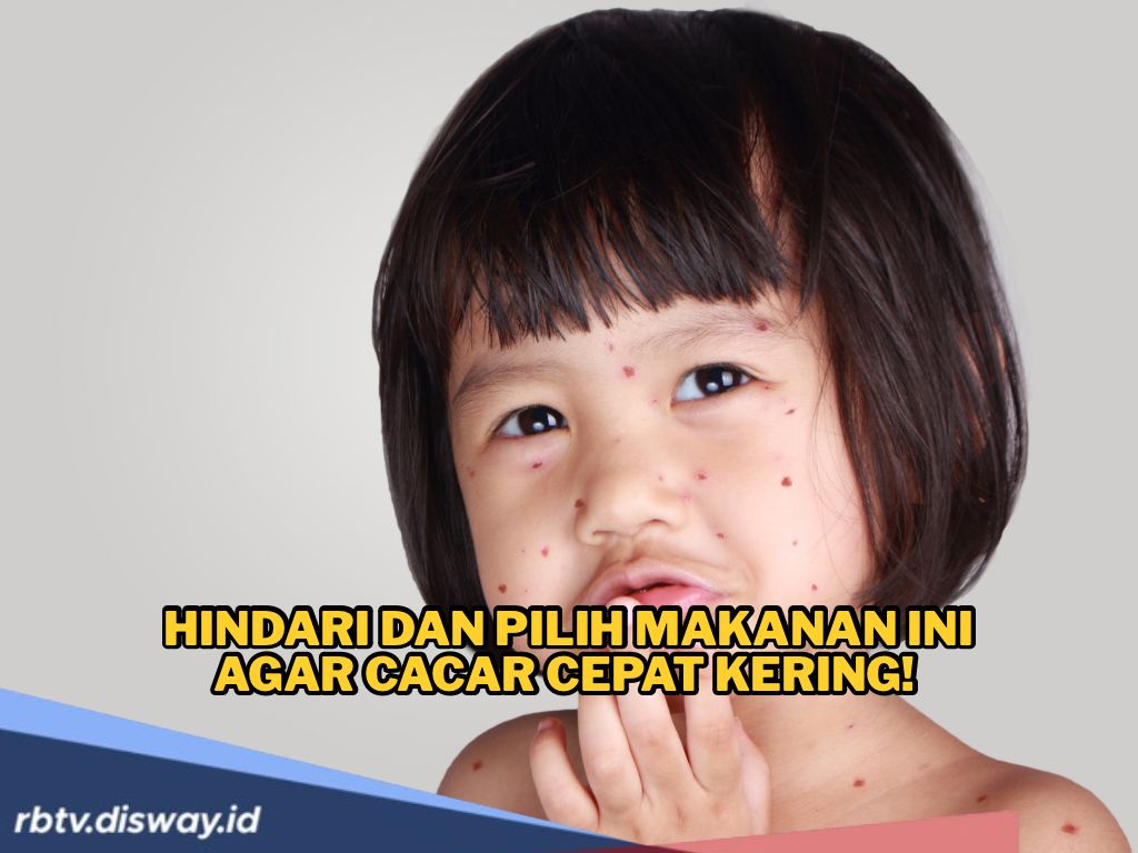 Hindari dan Pilih Makanan Ini agar Cacar Cepat Kering! Ini Anjurannya