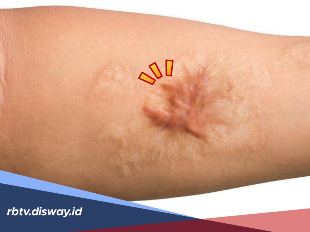 Kembalikan Rasa Percaya Diri, Hempaskan Keloid dengan Cara Alami Berikut