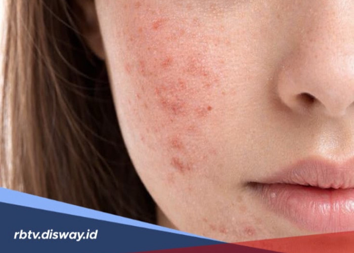 Urutan Pemakaian Skincare Malam yang Tepat untuk Menghilangkan Bekas Jerawat dan Flek