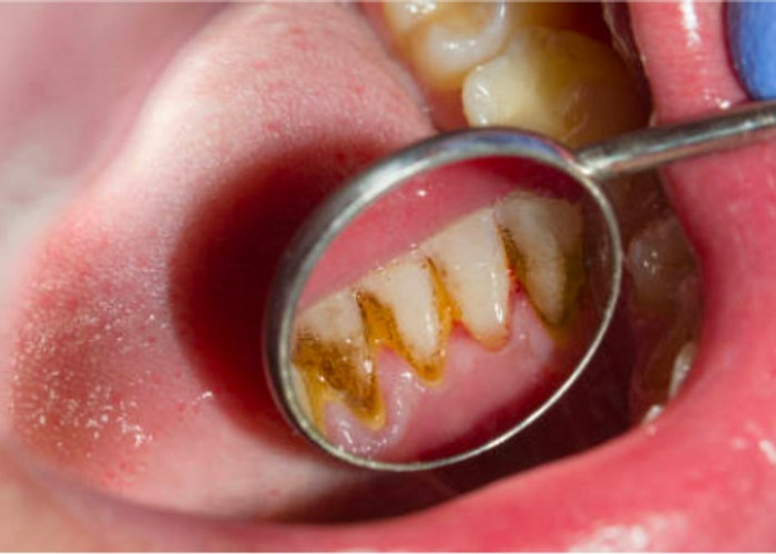 Kenali Penyebab Munculnya Karang Gigi, 7 Hal Ini Dapat Menghilangkan Karang Gigi Anda Secara Alami