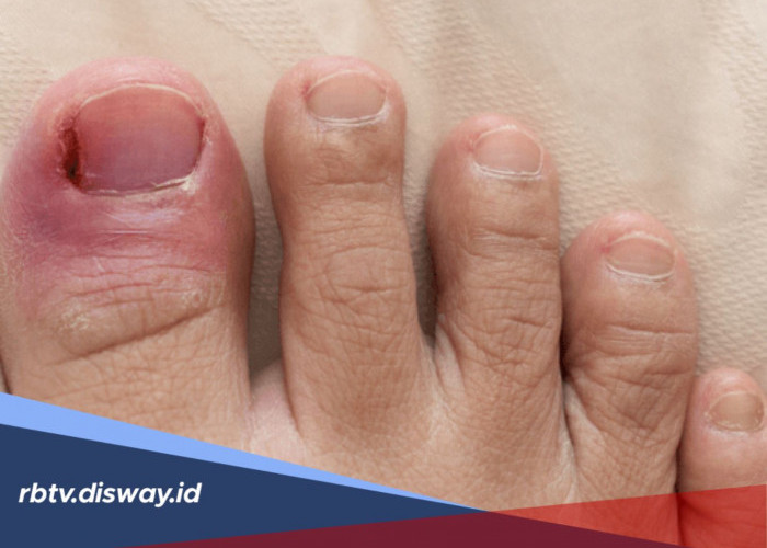 Kaki Terasa Nyut-Nyutan? Ini Cara Mengatasi dan Mencegah Cantengan