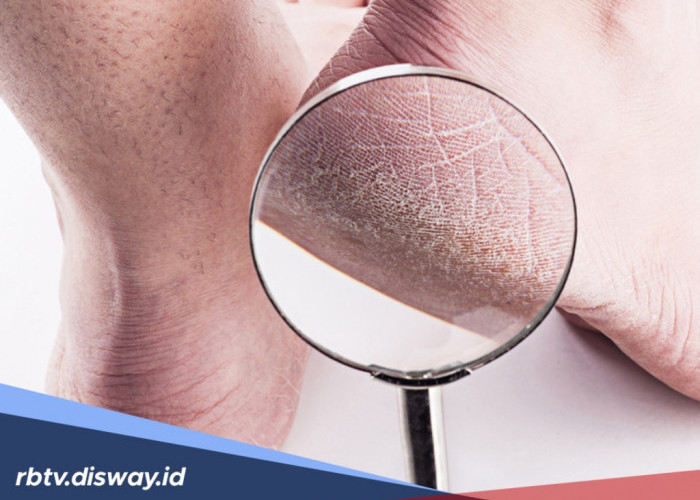 Tanpa Dokter, Ini 10 Cara Mengatasi Kaki Pecah-pecah Secara Permanen