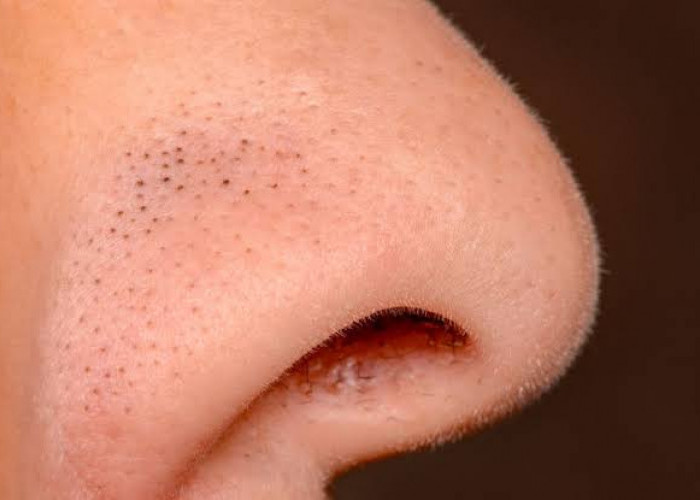 Mudah dan Efektif, 9 Cara Hilangkan Pori-Pori Hitam di Hidung Agar Tampil Lebih Percaya Diri