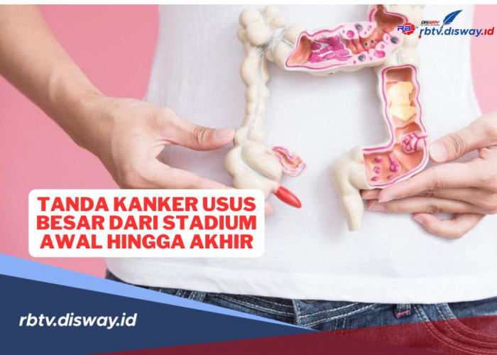 Kenali Tanda Kanker Usus Besar, Mulai dari Stadium Awal Hingga Staduim Akhir