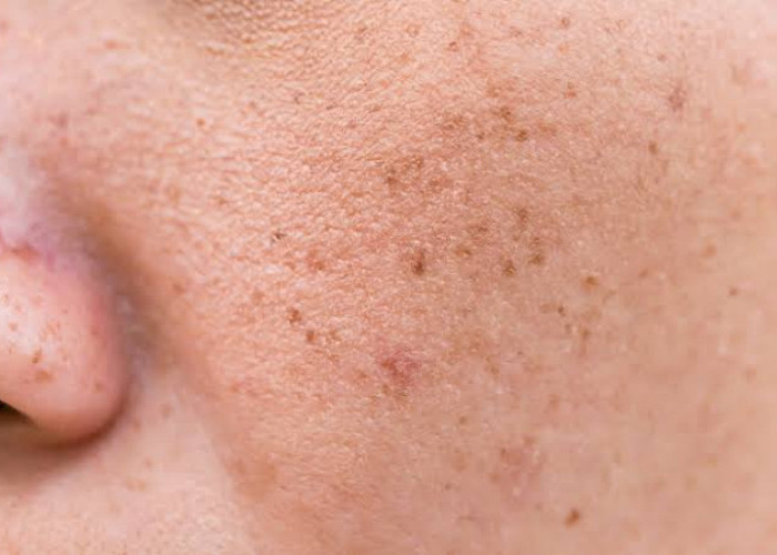 6 Cara Menghilangkan Pori-Pori Hitam di Wajah, Ketahui Juga Penyebabnya