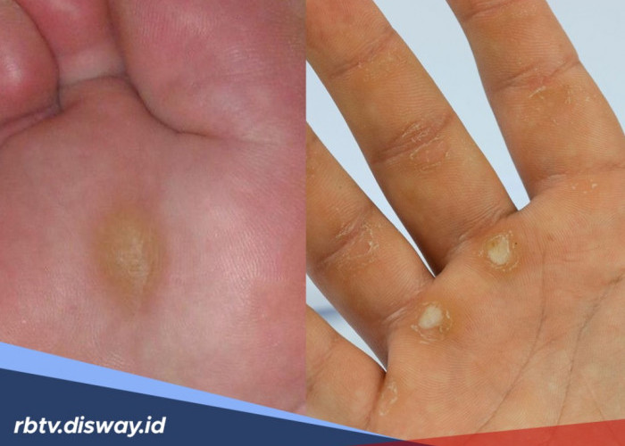 7 Cara Menghilangkan Kapalan di Kaki dan Tangan Secara Permanen