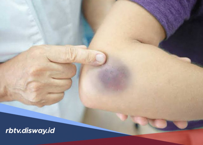 Mengenal Hematoma, Penyebab, Gejala, dan Cara Mengobatinya