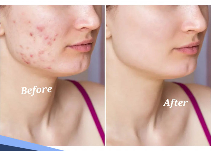 Ini Dia Cara Menghilangkan Bopeng Bekas Cacar, Dijamin Ampuh dan Sembuh