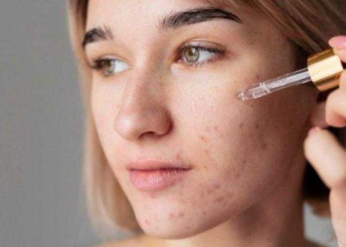 5 Skincare Korea untuk Kulit Berjerawat, Wajah Mulus Bebas Breakout