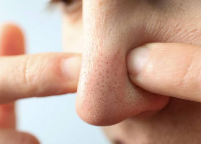Cara Menghilangkan Pori-pori di Hidung Agar Terlihat Mulus, Gunakan 15 Tips Mudah Ini Saja