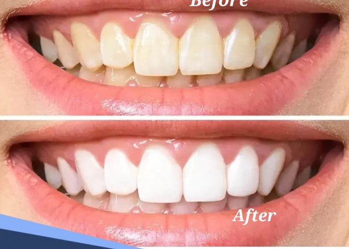 Tak Perlu Mahal, Begini Cara Memutihkan Gigi dengan Bahan Alami 