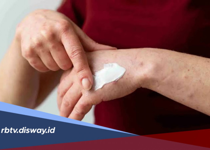 4 Rekomendasi Salep yang Ampuh Hilangkan Gatal di Kulit, Tersedia di Apotek