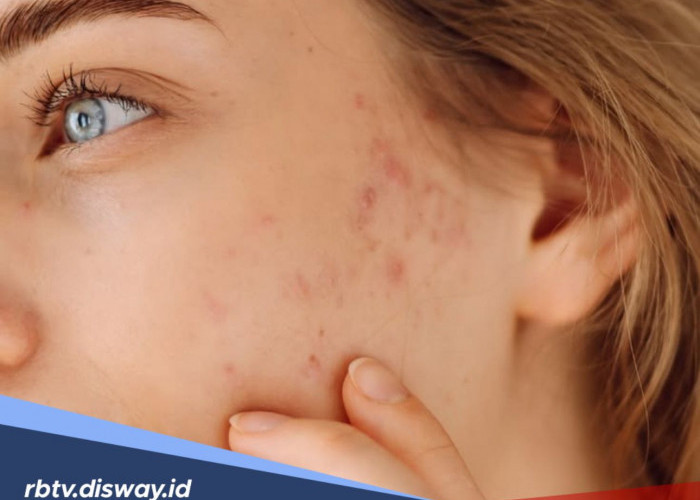 5 Cara Menghilangkan Bekas Jerawat dengan Bahan Alami