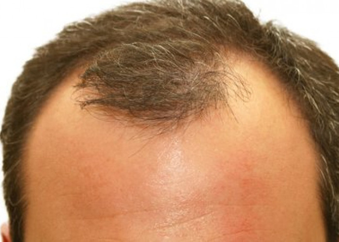 Rambut Botak Depan Hurup M, Ini 15 Cara Mudah Menumbuhkannya, Diantaranya Minyak Atsiri