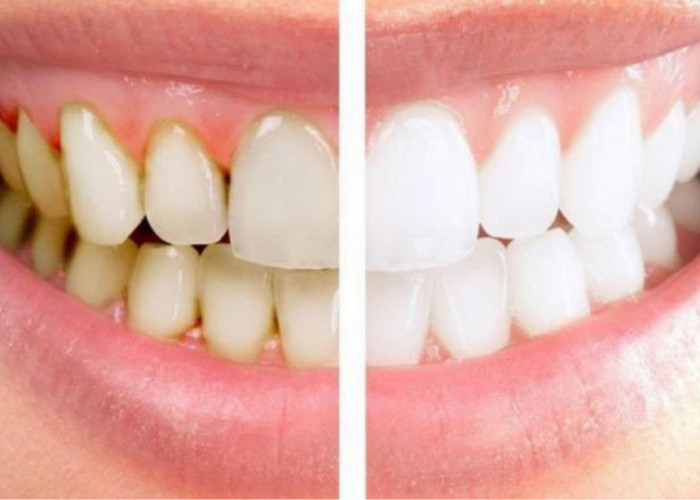 Ada Cara Mudah Membersihkan Karang Gigi tanpa Harus ke Dokter, Tidak hanya Rutin Sikat Gigi