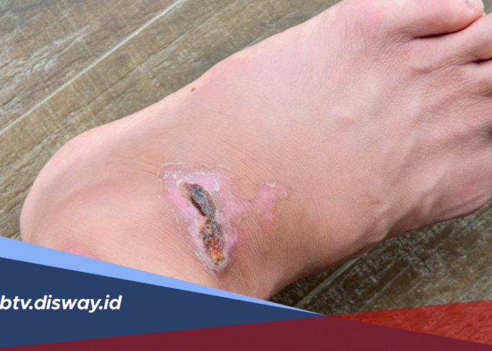 Ini Rahasianya dan Perawatan Menghilangkan Koreng di Kaki
