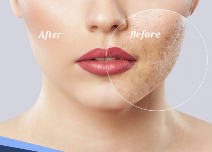 Terbukti Ampuh, Begini Cara Mudah Hempaskan Bopeng Bekas Jerawat 