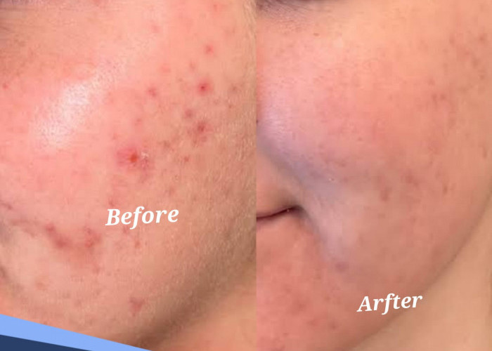 Rahasia Wajah Mulus, Ini Cara Menghilangkan Jerawat dengan Bahan Alami