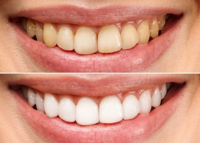 Kopi Juga Bisa Menyebabkan Gigi jadi Kuning, Tapi Tenang Ini 9 Cara Menghilangkan Gigi Kuning Bekas Kopi