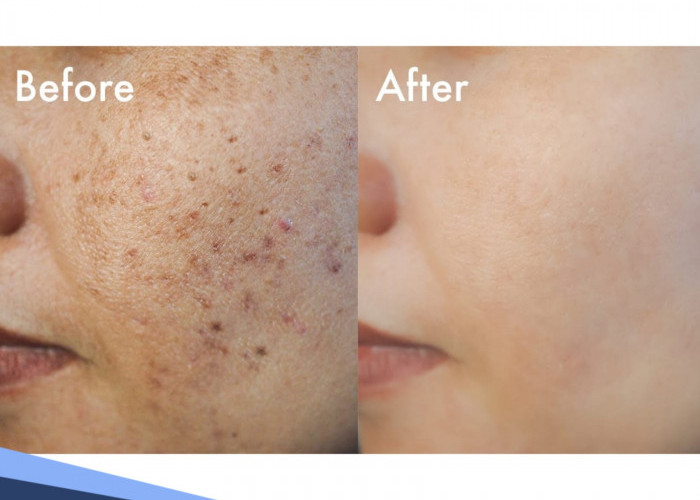 Cara Ampuh Menghilangkan Bopeng di Wajah, Bikin Tampil Lebih Percaya Diri