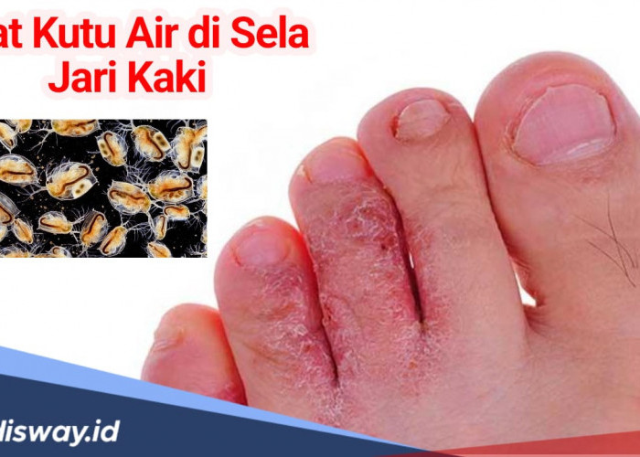 4 Obat Kutu Air di Sela Jari Kaki, Bisa Pakai Bumbu Dapur