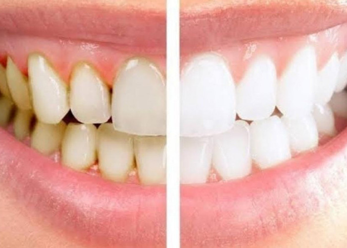 Ini 7 Cara Sederhana Menghilangkan Karang Gigi Membandel, Hasilnya Bikin Takjub  