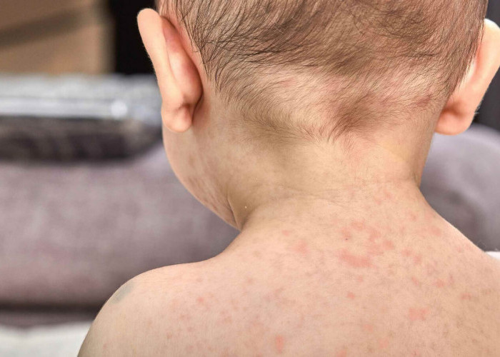 Sering Menyerang Anak-anak, Kenali Penyebab Penyakit Kawasaki dan Cara Pengobatannya