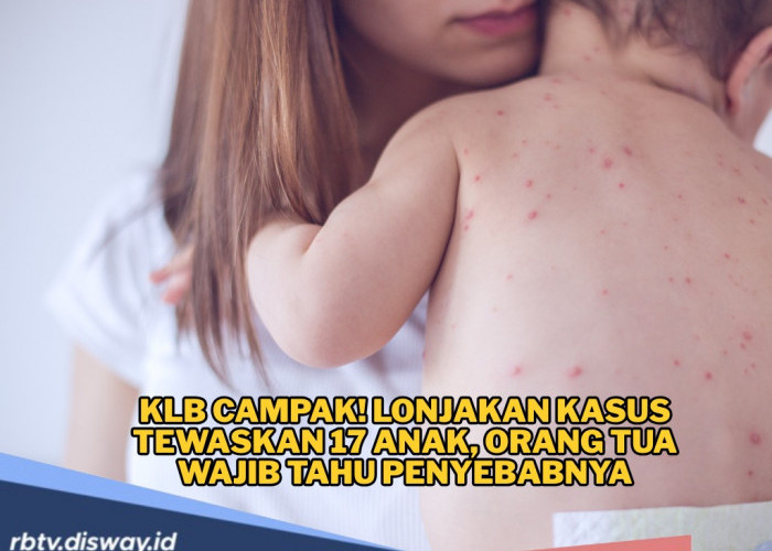 KLB Campak Semakin Ganas, Sebenarnya Apa Itu Campak? Kenali Gejalanya