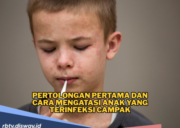 Kasus Campak Tinggi di Jawa Timur, Ini Pertolongan Pertama yang Bisa Dilakukan