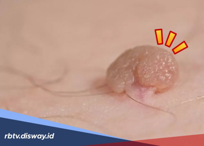 5 Cara Alami Menghilangkan Kutil yang Buat Kamu Kurang Pede