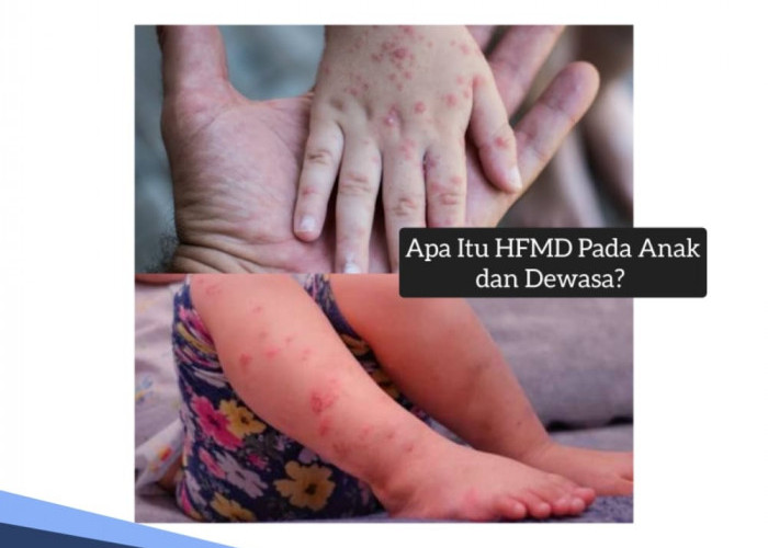 Apa Itu HFMD atau Flu Singapura pada Anak dan Dewasa? Ini, Gejala dan Cara Pengobatannya