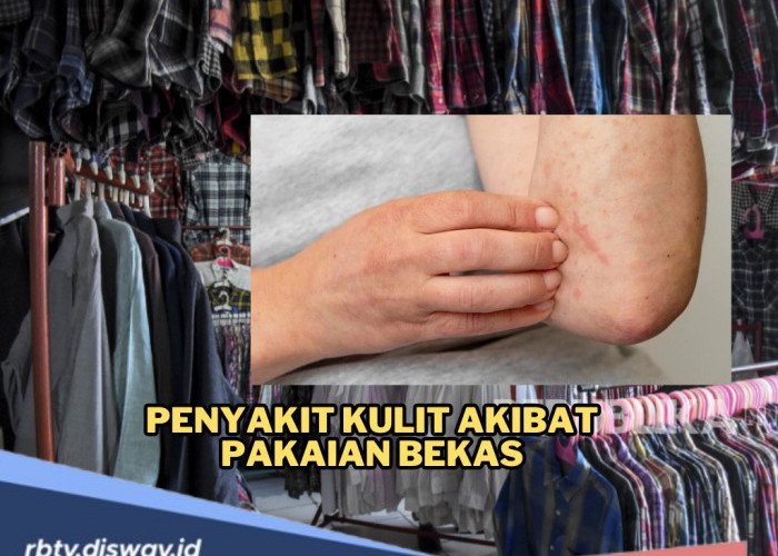 Hati-Hati! Tren Thrifting Bisa Bikin Kulit Bermasalah, Ini Bahaya Baju Bekas yang Dipakai Tanpa Dicuci 