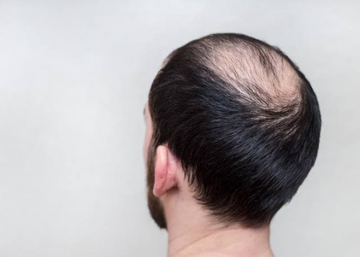 Gak Perlu Transplantasi Rambut, Kebotakan Bisa Langsung Ditangani Cukup Gunakan Telur 