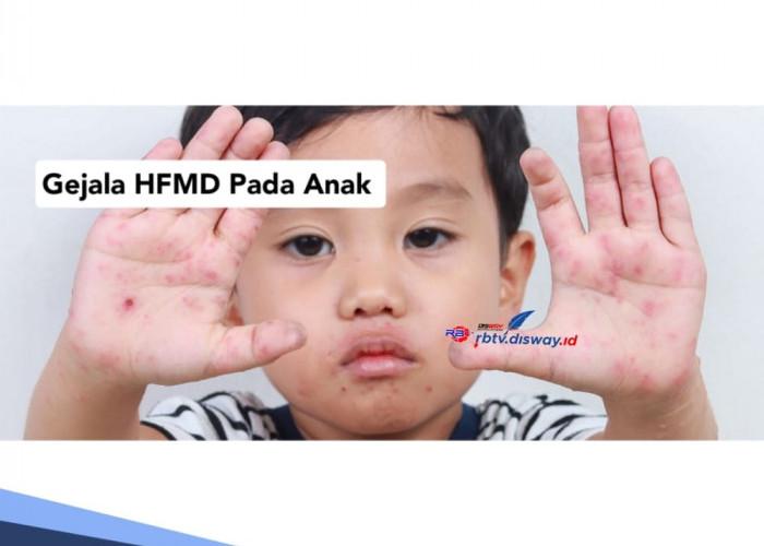 Gejala HFMD atau Flu Singapura pada Anak, Ini Langkah yang Harus Ibu Lakukan untuk Pencegahan