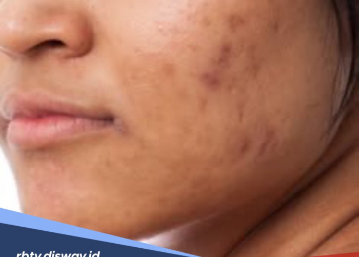 Skincare Terbaik yang Terbukti Ampuh Memudarkan Bekas Jerawat Hitam (PIH) dengan Cepat