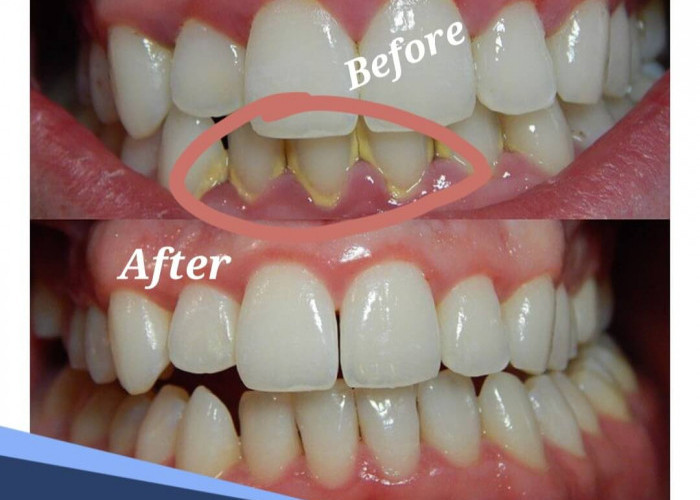 Bukan Sulap, Ini Cara Menghilangkan Karang Gigi Membandel Secara Alami 