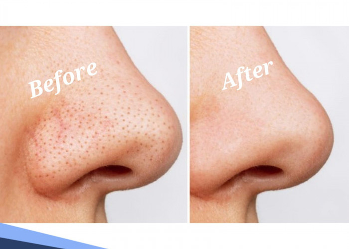 Bukan Dipencet, Begini Cara Menghilangkan Komedo dengan Bahan Alami