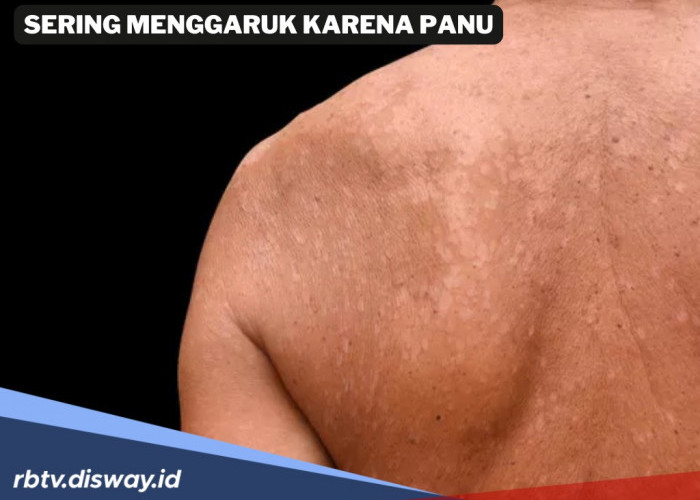 Sering Garuk Karena Gatal-gatal Akibat Panu, Basmi Panu dengan 11 Tanaman Obat Keluarga Berikut