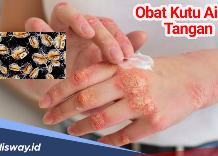 7 Jenis Obat Kutu Air Ditangan yang Ampuh, Mudah Didapat dan Harganya Murah