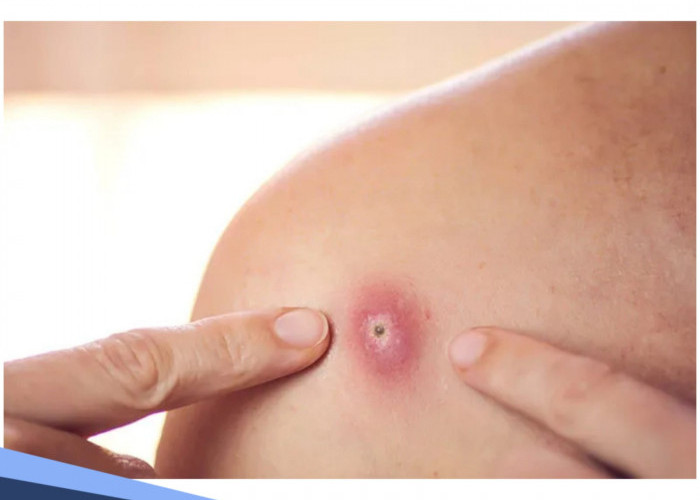 4 Cara Mengobati Bisul dengan Bahan Alami, Dijamin Kempes