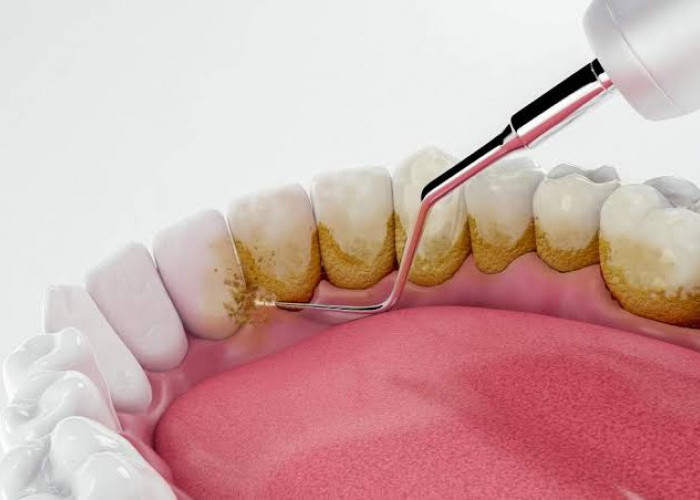 Jangan Anggap Remeh,Ternyata Ini Bahaya Karang Gigi Jika Telat Ditangani,  Bisa Kena Penyakit Kronis