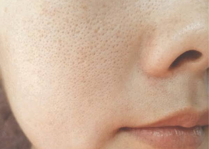 Cara Menghilangkan Pori-Pori Tersumbat di Wajah, 5 Cara Ini Dijamin Efektif