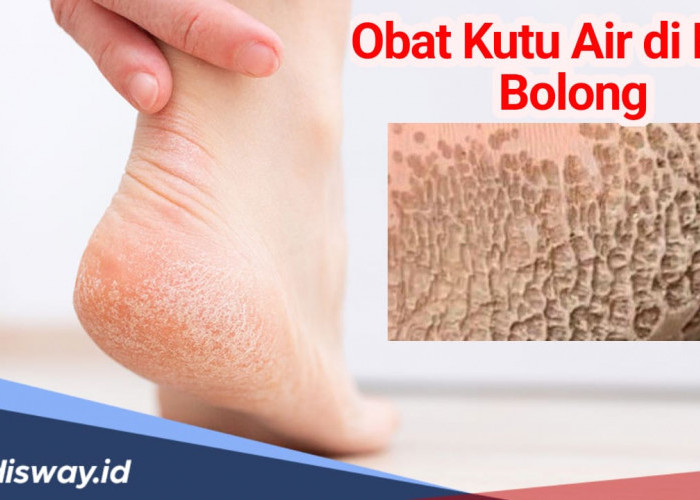 Obat Kutu Air di Kaki jika Sampai Bolong, Bisa Langsung Dicoba 