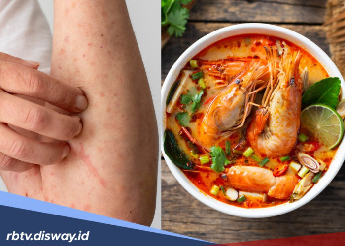 Gatal Usai Makan Udang? Inilah Fakta Alergi yang Perlu Kamu Tahu